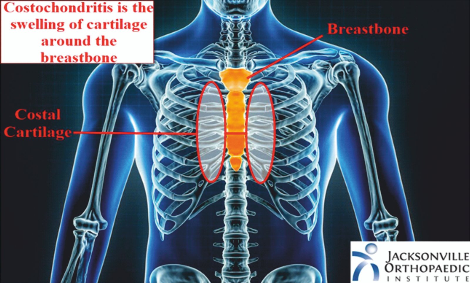 COSTOCHONDRITIS | Current Affairs Editorial, Notes by VajiraoIAS