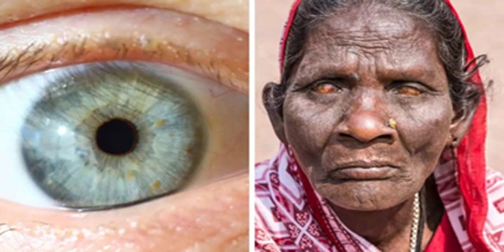 WHO DECLARES INDIA FREE OF TRACHOMA